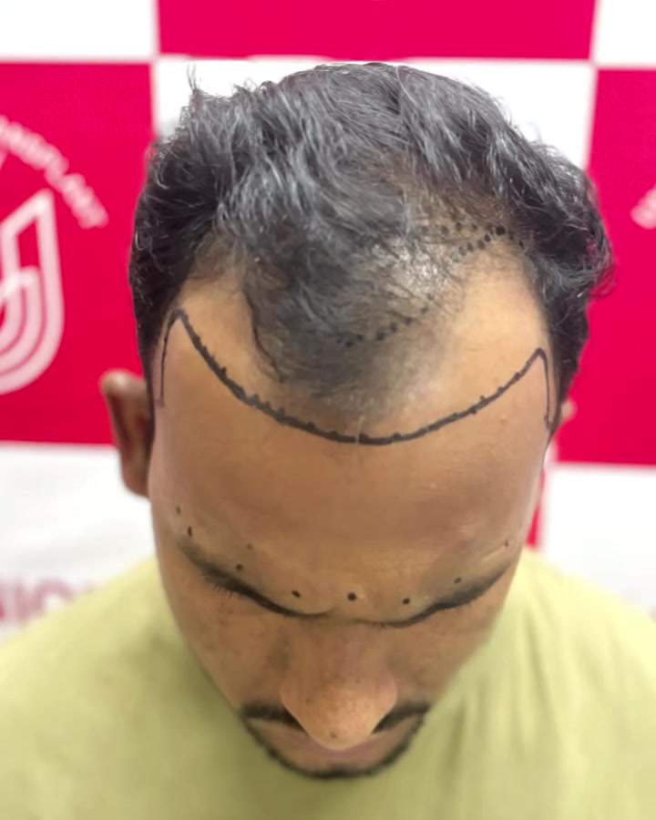 A new hairline drawn in marker on a patient's scalp before the procedure