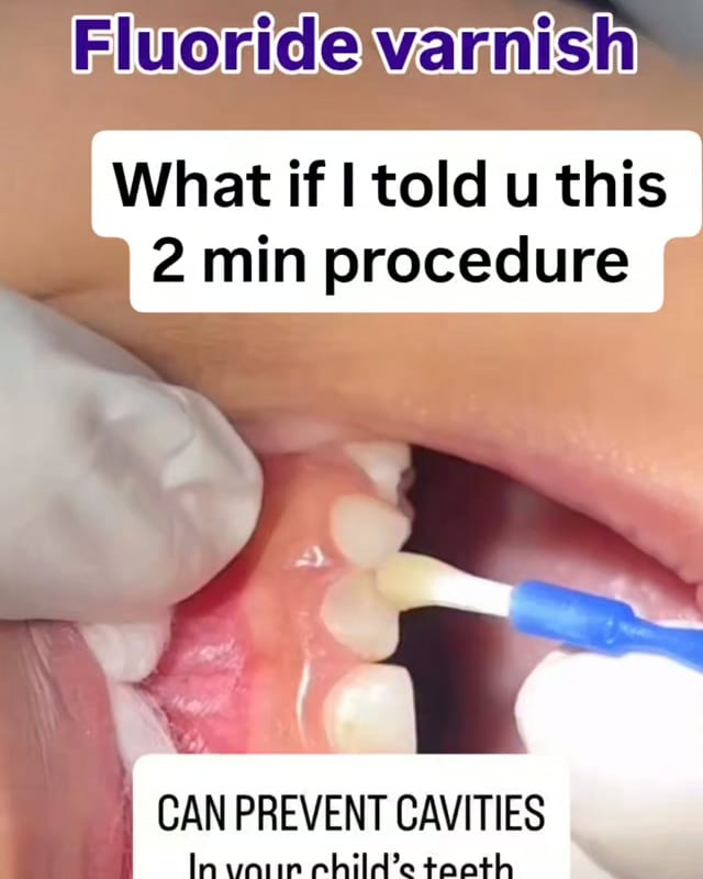 Fluoride varnish being painted onto a child's teeth — from the Happy Dentz Instagram